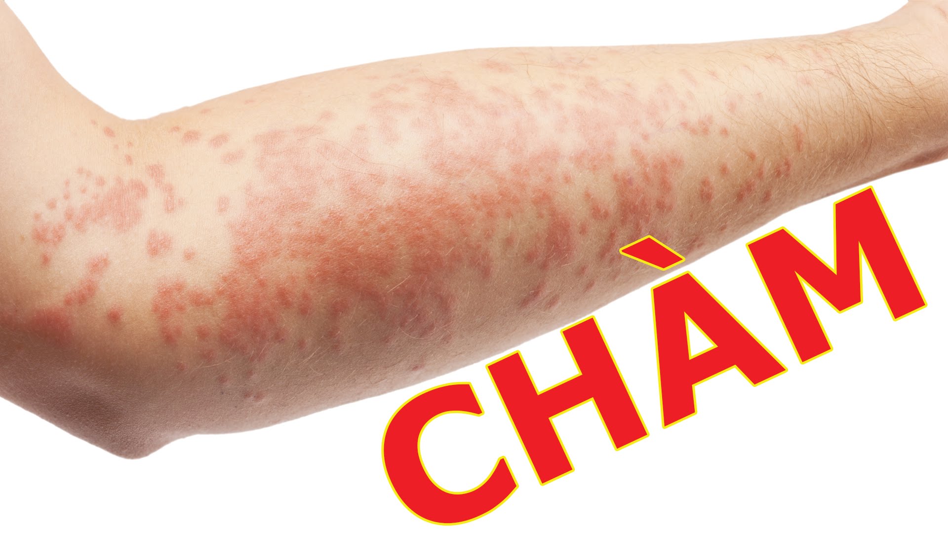 benh-cham-eczema
