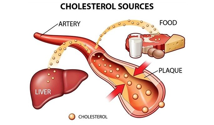 Tăng cholesterol máu được định nghĩa là khi chỉ số cholesterol tốt (HDL) tr...